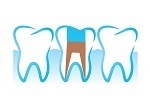 Root Canal in Toronto